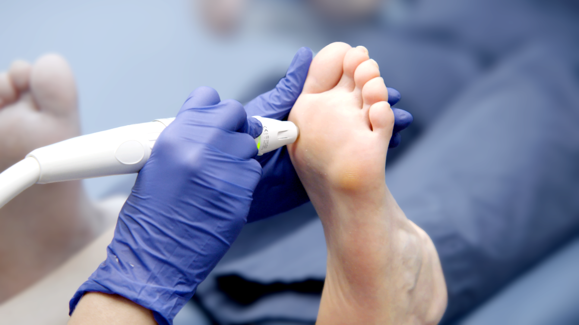 Best Verruca Treatment in Edinburgh