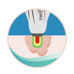 Image of Swift Microwave Therapy working on the surface
